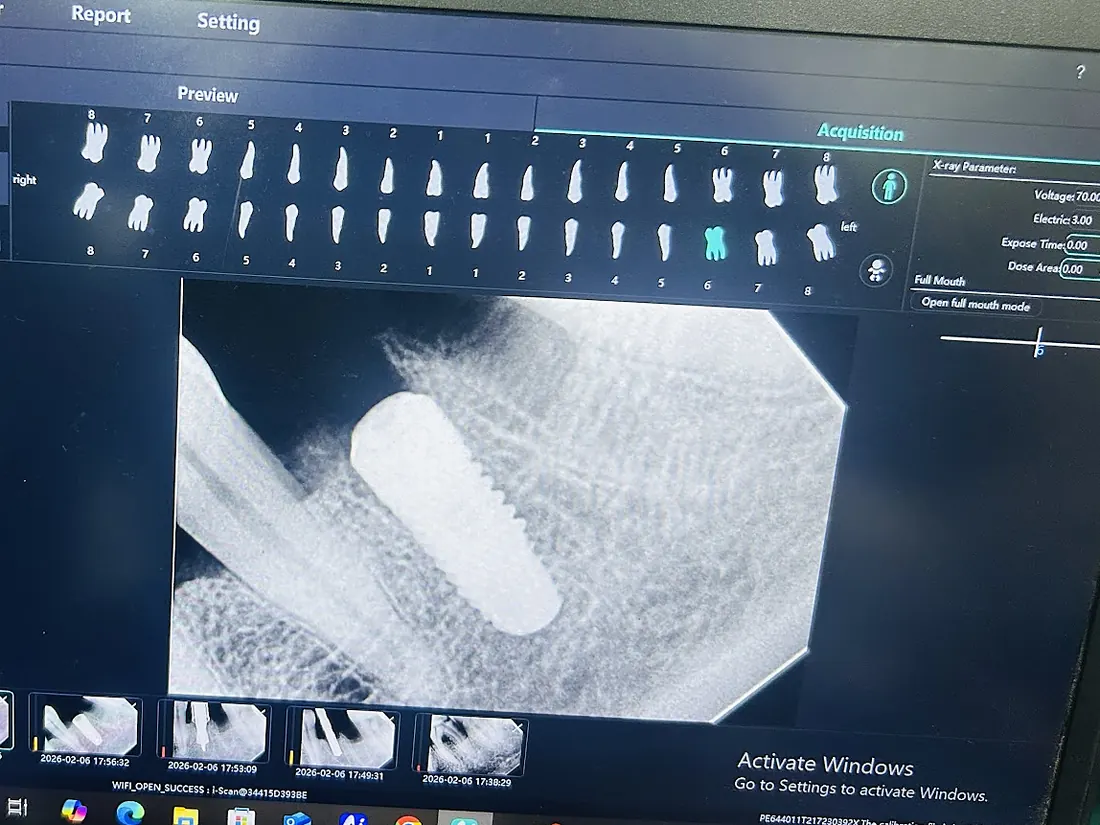 Dental implant X-ray read out on planning software at Rijul's Dental